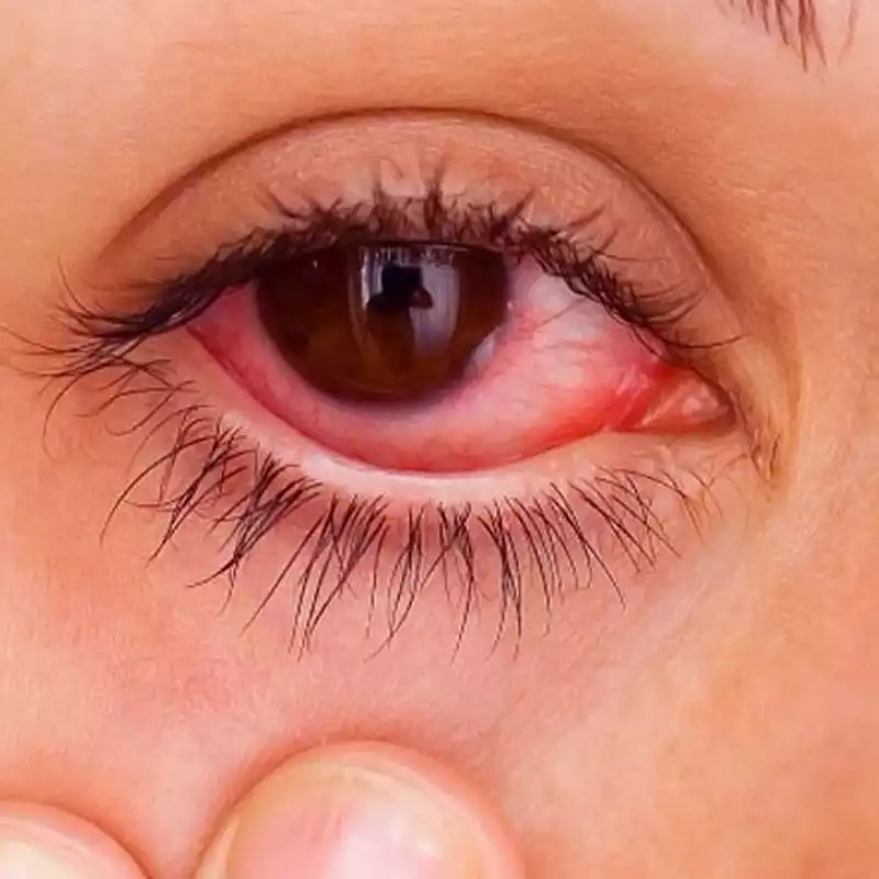 allergy lash extensions