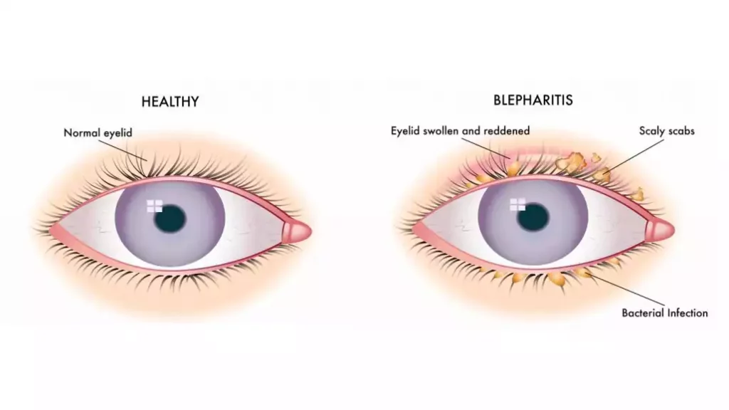 blepharitis lash extensions