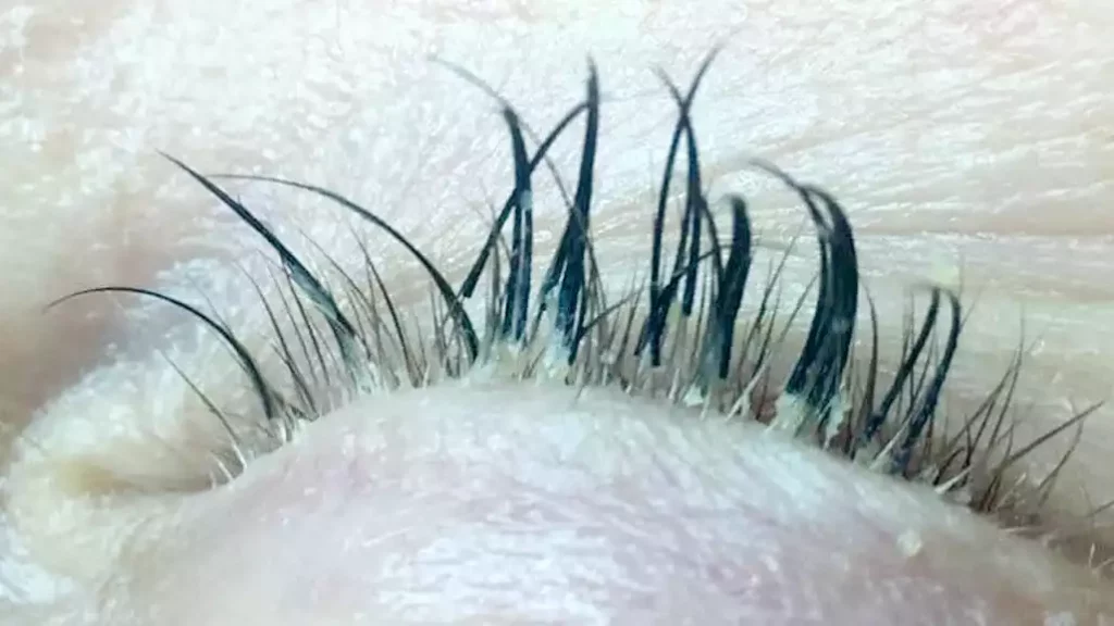 eyelash mites pictures