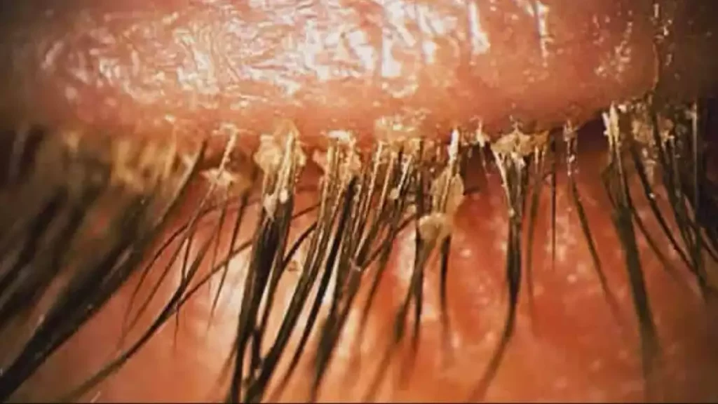 lash mites and eyelash extensions